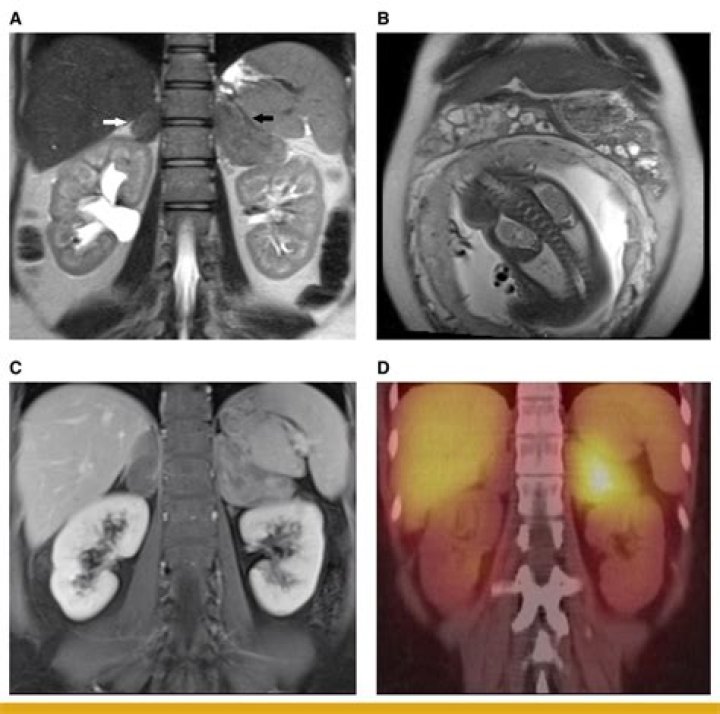 Are anaplastic astrocytomas hereditary?