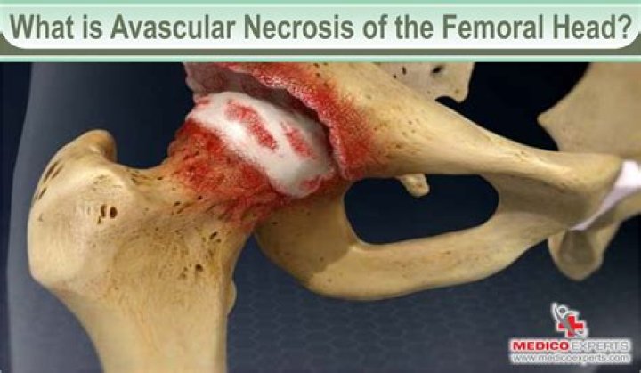 Can avascular necrosis heal on its own?