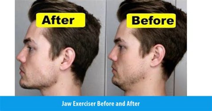 Does the jaw exerciser work?