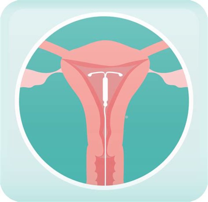 Is a displaced iud an emergency?