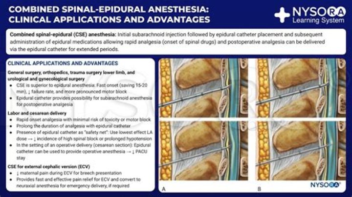 Is spinal anesthesia intrathecal?